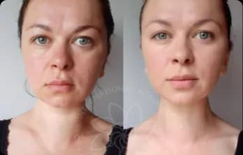 Swelling has disappeared, facial contours are tightened, the face looks slimmer and younger.